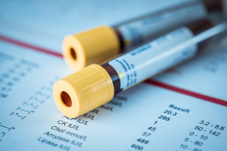An image of two blood test tubes on top of a blood test result document.