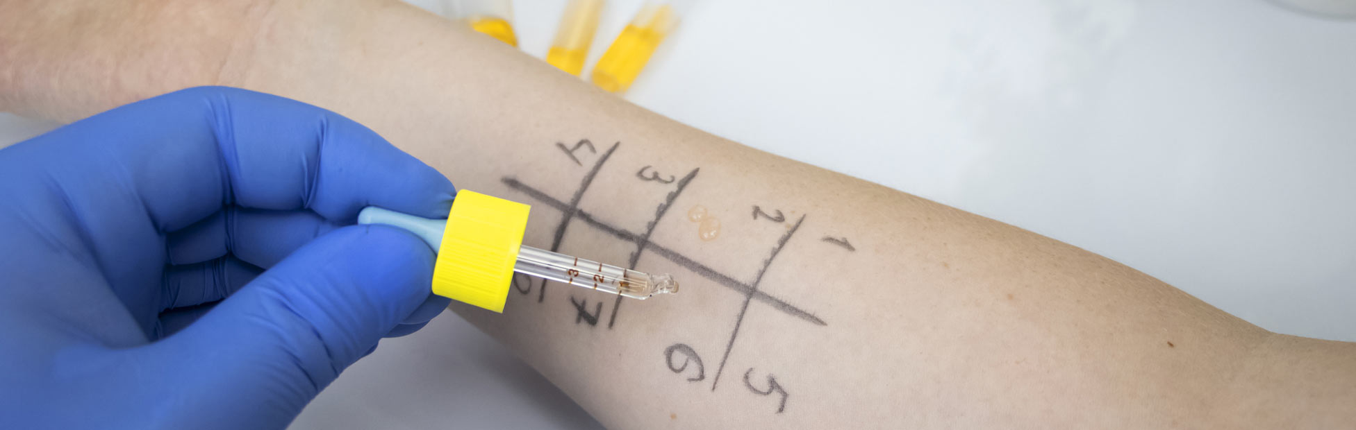 An allergist doctor conducting a prick allergy test